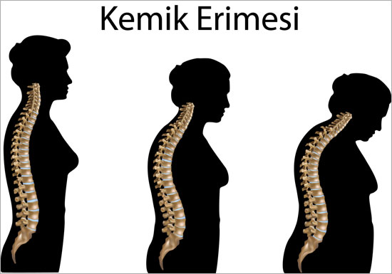 Kemik Erimesi Nedir